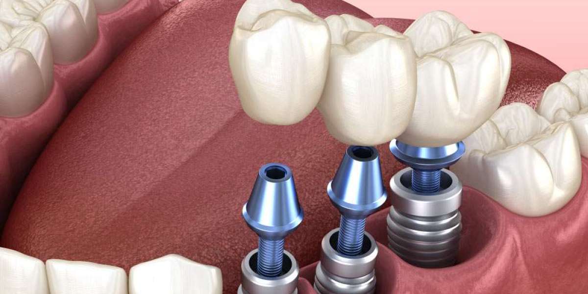 How Bone Grafting Supports Dental Implants