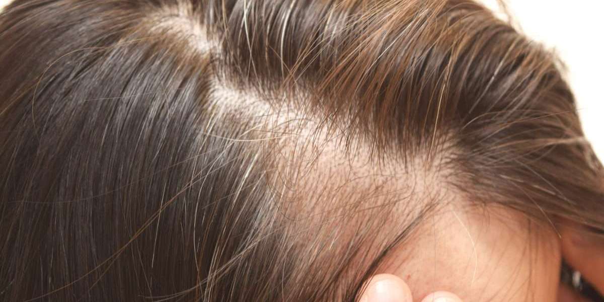 What Is the Recovery Time for PRP Hair Treatment?