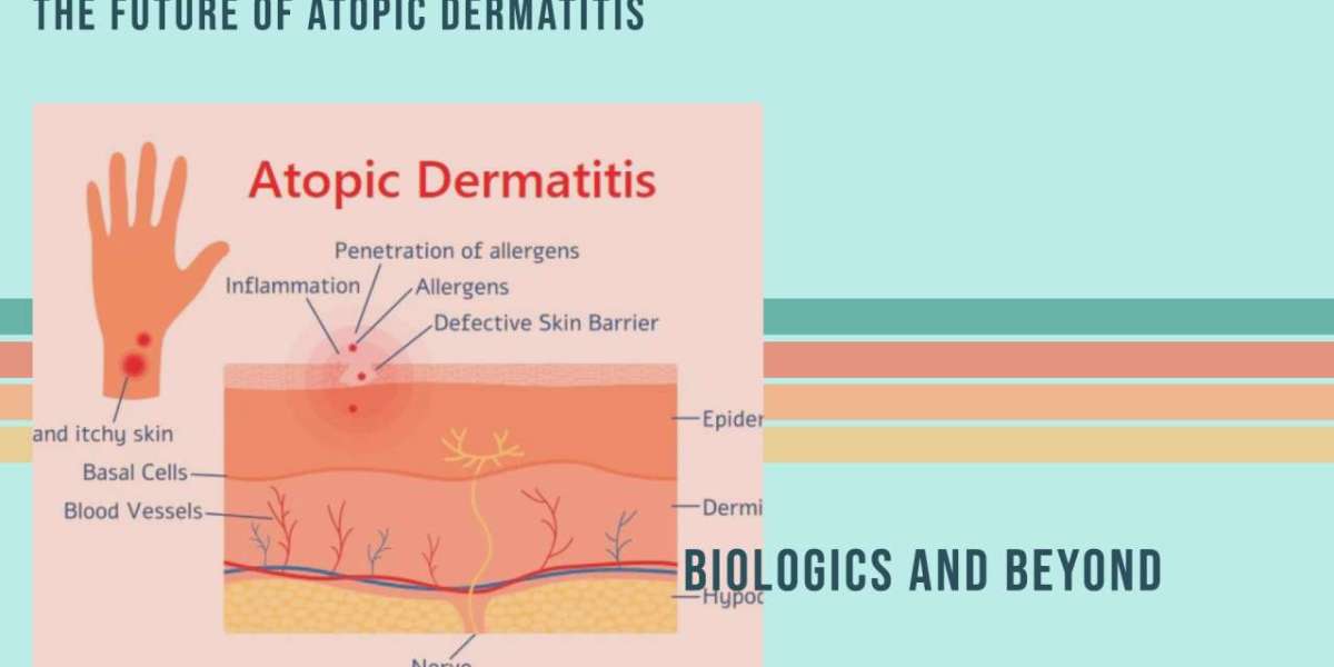 Patient-Centric Care: Improving Atopic Dermatitis Outcomes