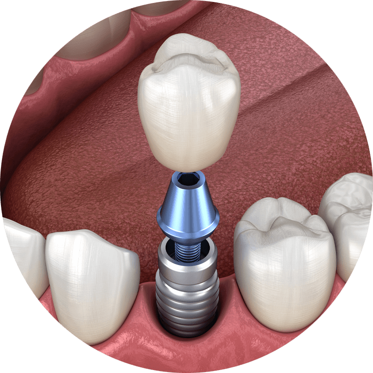 Dental Implants in Jaipur | FaceKraft Dental Implant Clinic