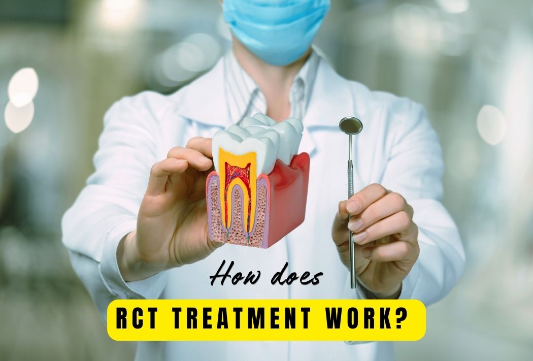 How does RCT treatment work? | Teethcare