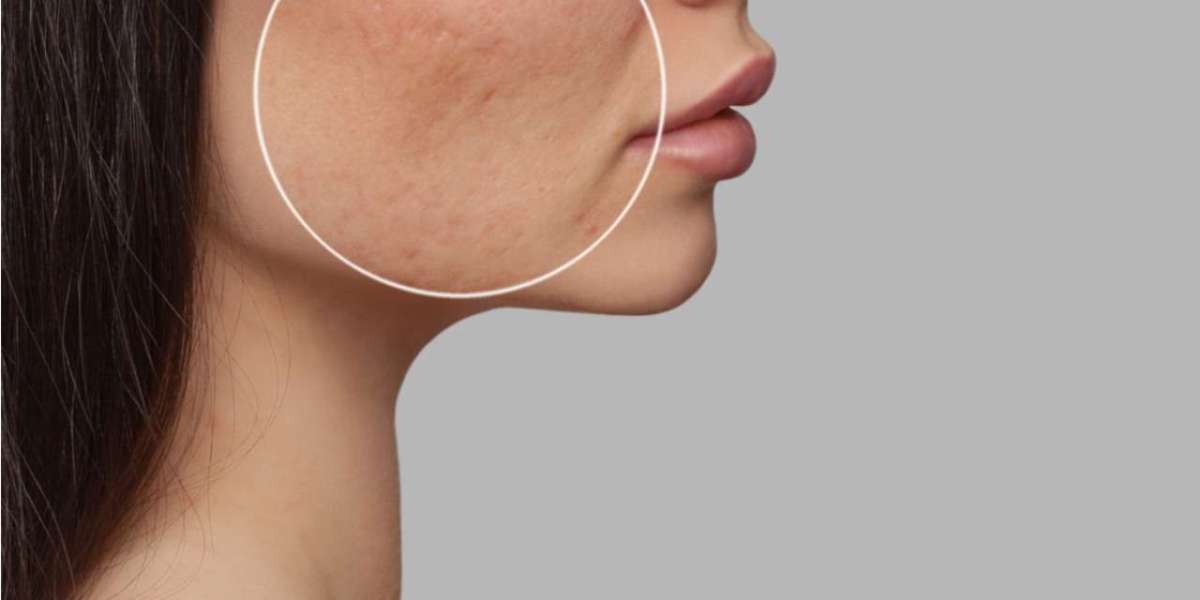 Are Acne Scars Embarrassing?