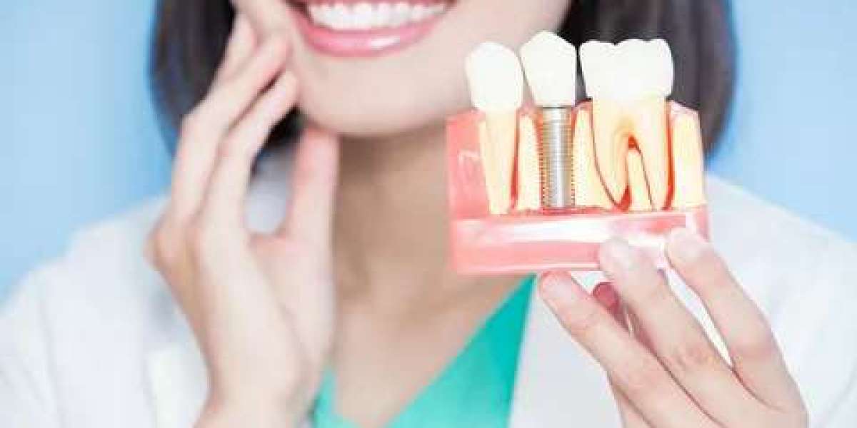 The Evolution of Dental Implants in Islamabad Over the Years