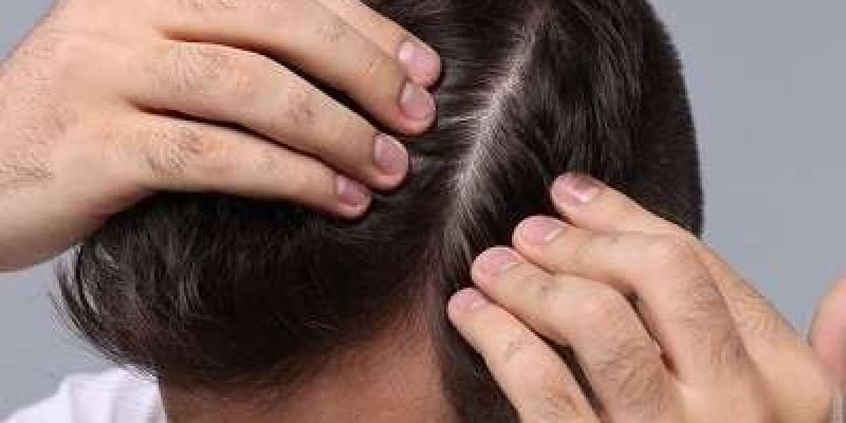 What to Know Before Getting a Hair Transplant in Islamabad