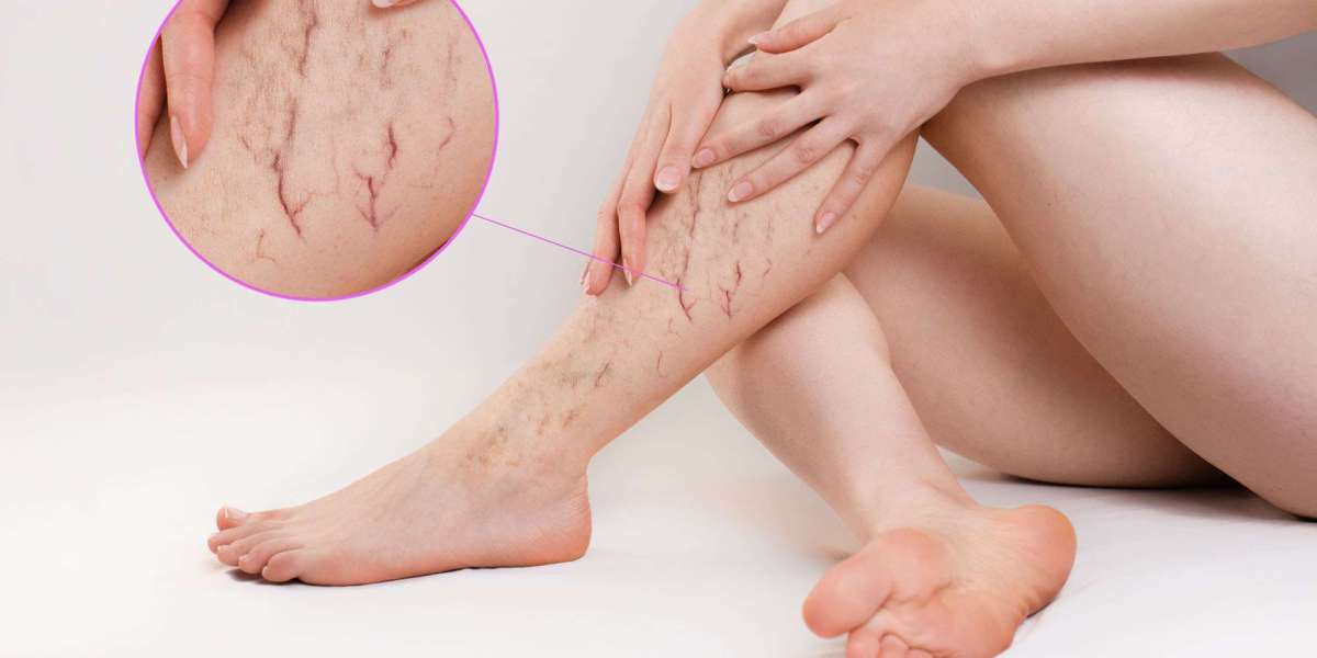 Can Spider Veins Disappear with Exercise?