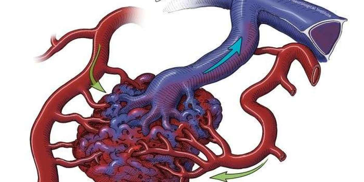 Understanding Vascular Malformation and Uterine Fibroids: Implications and Treatments