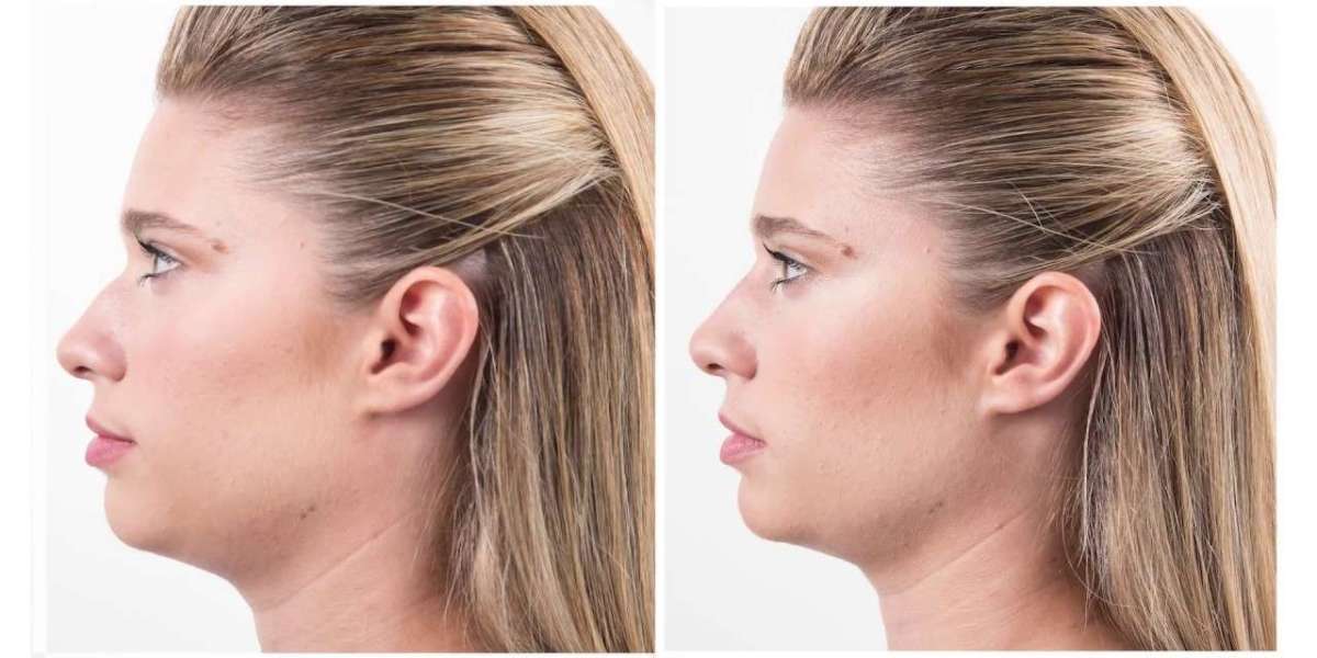 Is Rhinoplasty Customizable to Your Preferences?