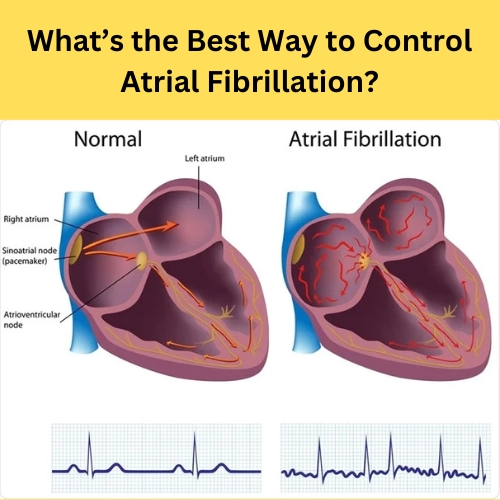 What’s the Best Way to Control Atrial Fibrillation? - Natural Health News