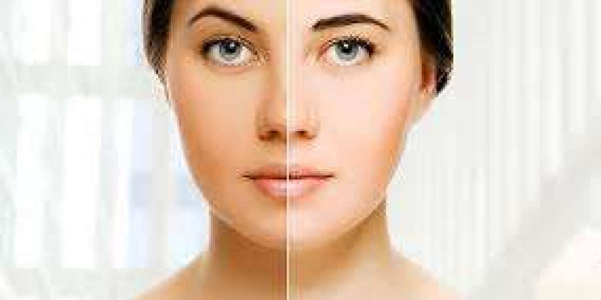 Skin Whitening Treatment in Dubai: Is it Right for You?