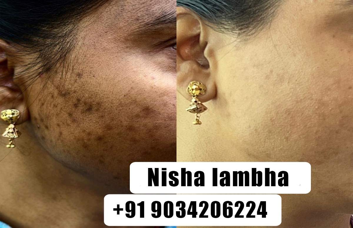 Pigmentation treatment for face