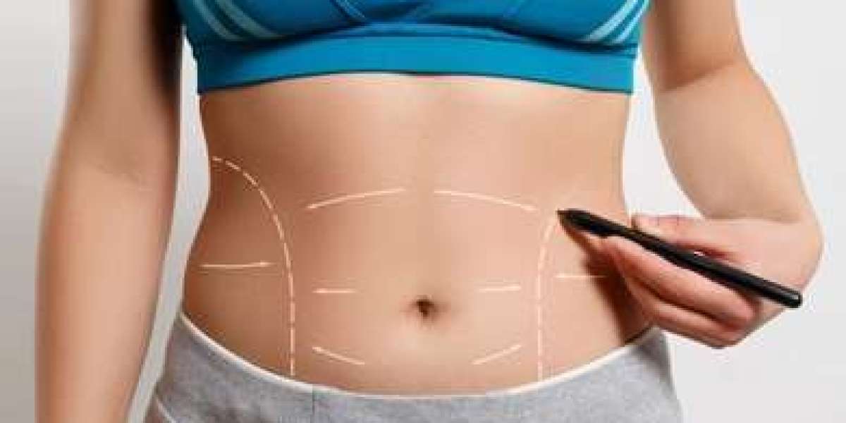 The Benefits of Liposuction for Body Confidence and Mental Wellbeing