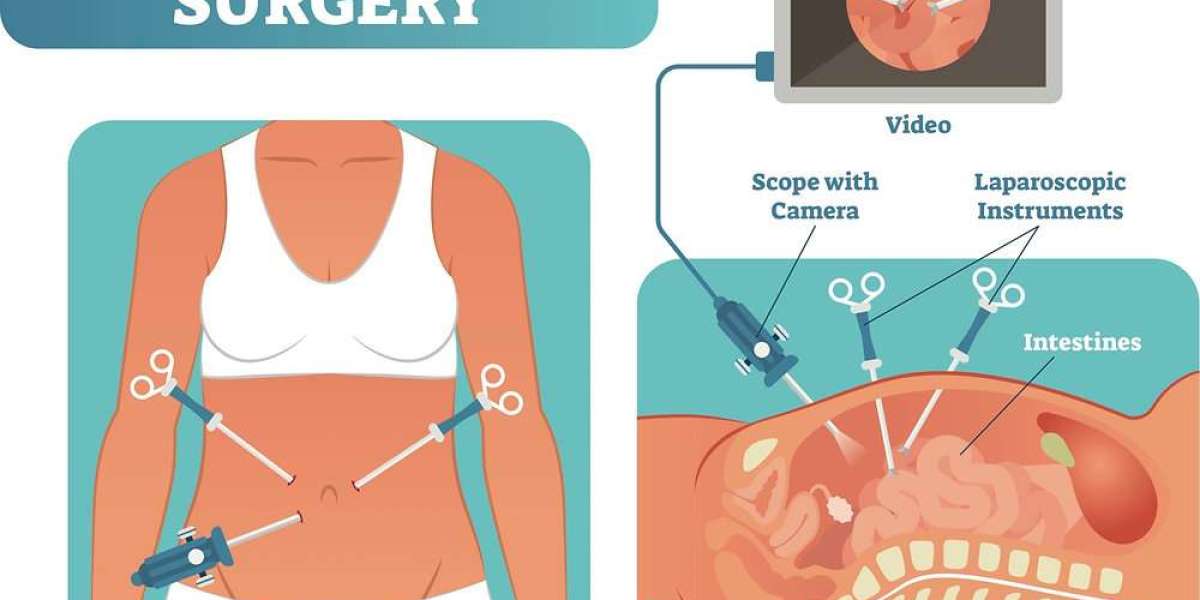 Laser and Laparoscopic Surgery: A Revolutionary Approach to Minimally Invasive Treatment