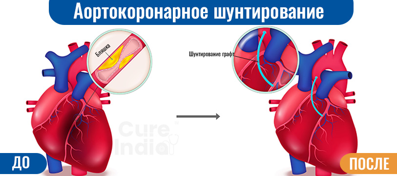 аортокоронарное шунтирование между Россией и Индией