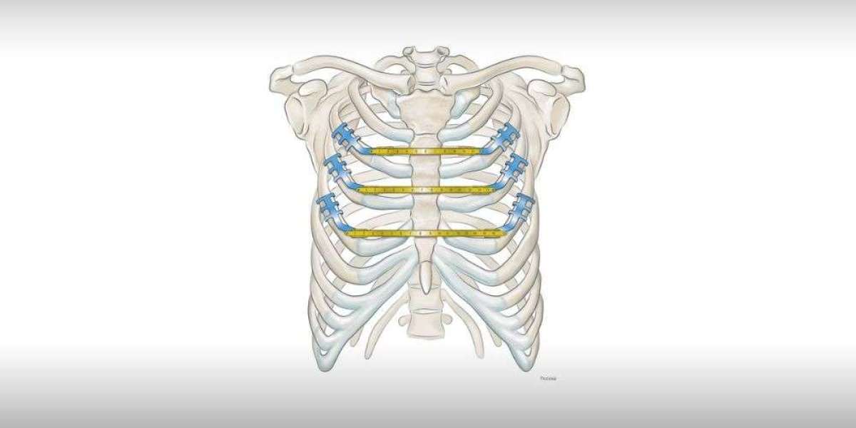 Sternal Closure Systems Market Comprehensive Study Explores Huge Growth to the Forecast 2030