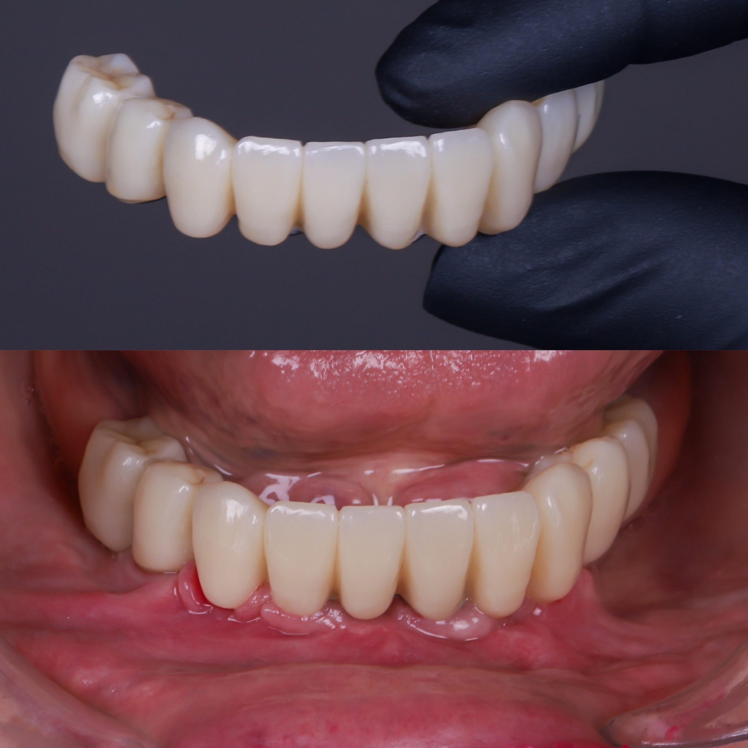 dentadura fija sobre 4 implantes precio