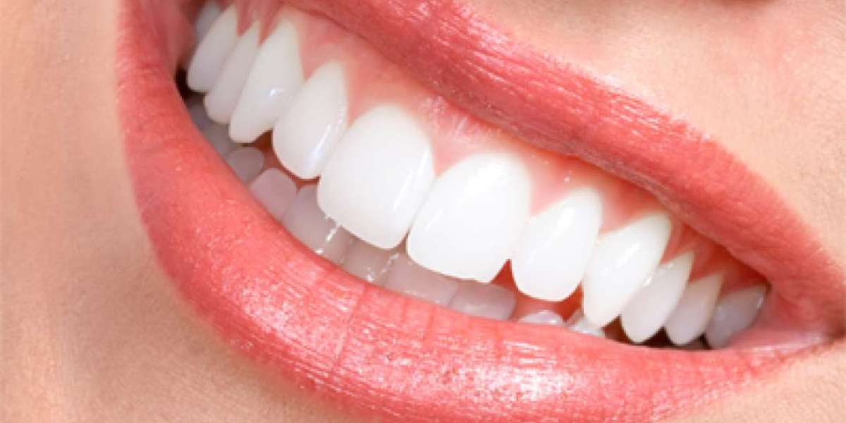 Dental Veneers: A Simple Way to Improve Tooth Appearance
