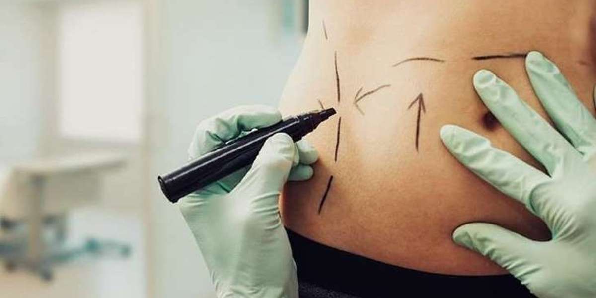 Non-Surgical BBL: Everything You Need to Know