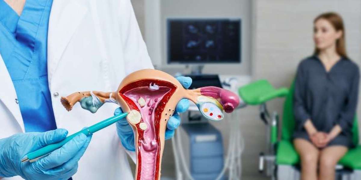 What Doctors Want You to Know About Fibroid Embolization