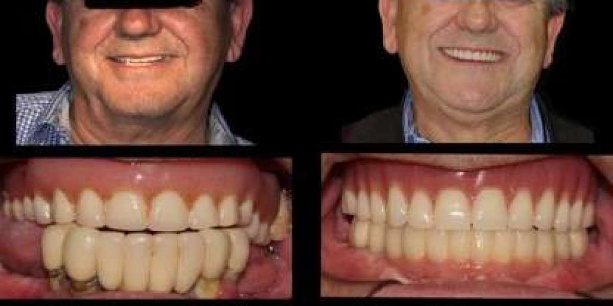 Implantes de Carga Inmediata en Hospitalet de Llobregat Tratamiento Rápido y Seguro
