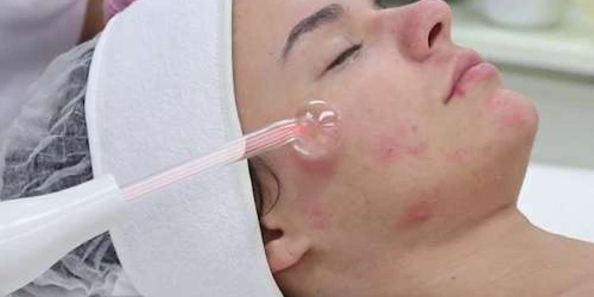 Acne-Prone Skin? Here's Your Management and Treatment Guide