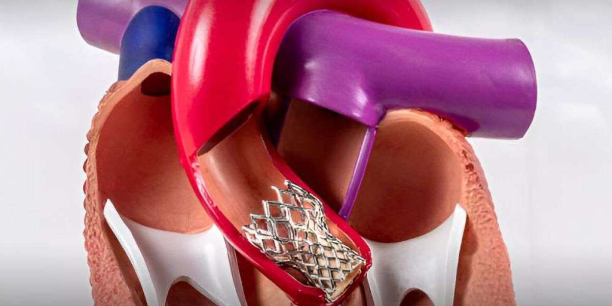 Transcatheter Aortic Valve Implantation Market In-depth Insights, Revenue Details and Regional Analysis by 2030