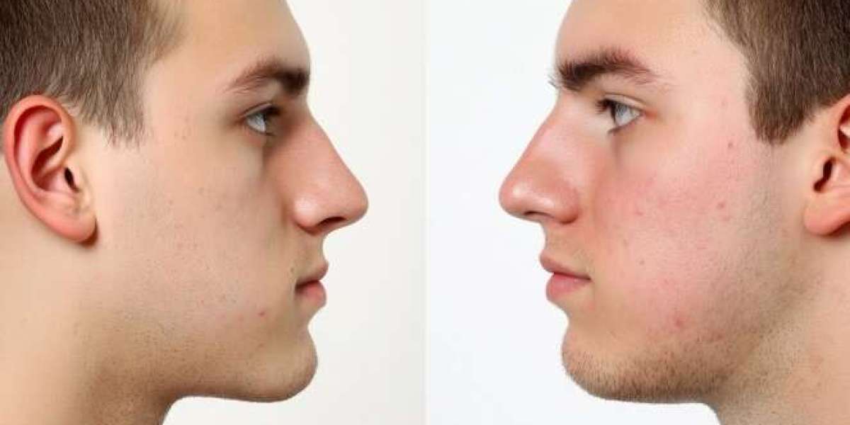 Signs Your Nose Is Ready for Rhinoplasty