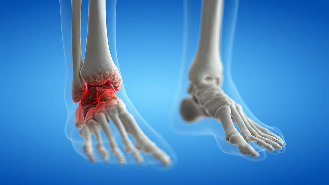 Foot and Ankle Arthritis: How to Relieve and Prevent It | My FootDr