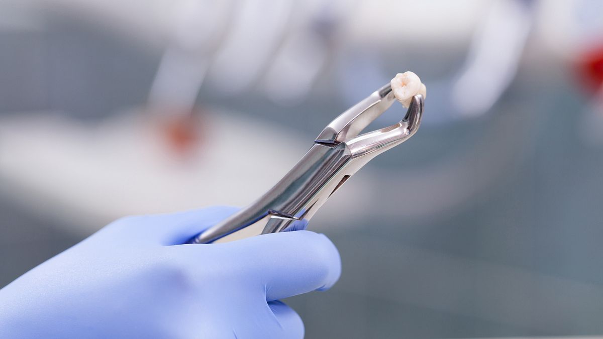Why You Should Avoid Ibuprofen After a Tooth Extraction | by Wise RX Card | Jun, 2025 | Medium