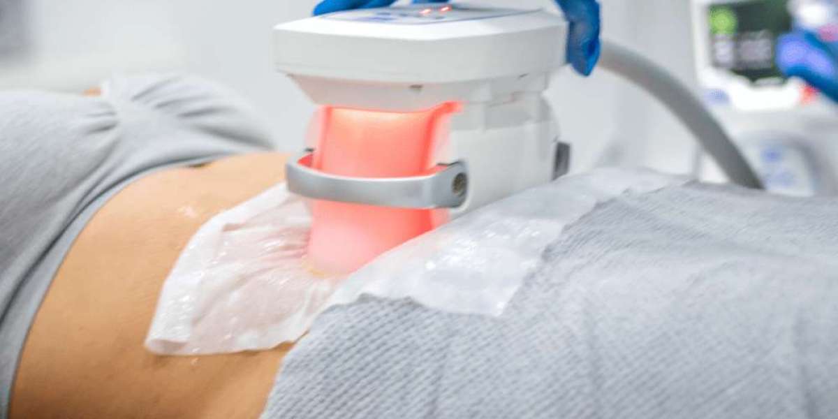 Does CoolSculpting Replace a Healthy Lifestyle?