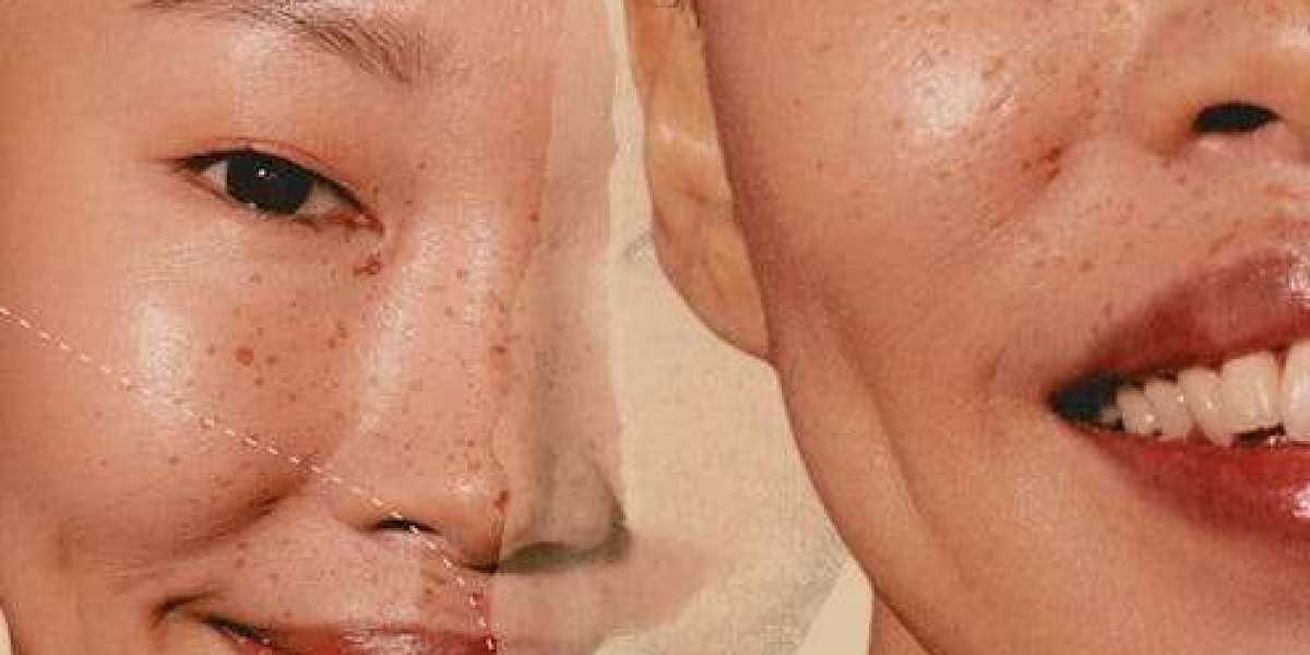 What Foods to Avoid After Dimple Creation?