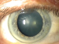 Best Laser Cataract Surgery specialist Westchester, New York