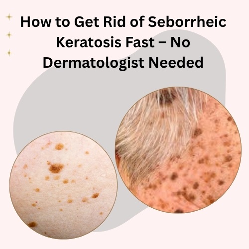 How to Get Rid of Seborrheic Keratosis Fast – No Dermatologist Needed - Natural Health News