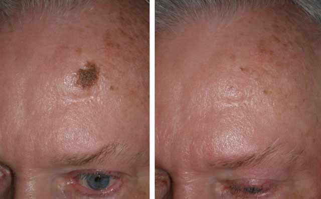Benefits of Laser Mole Removal London