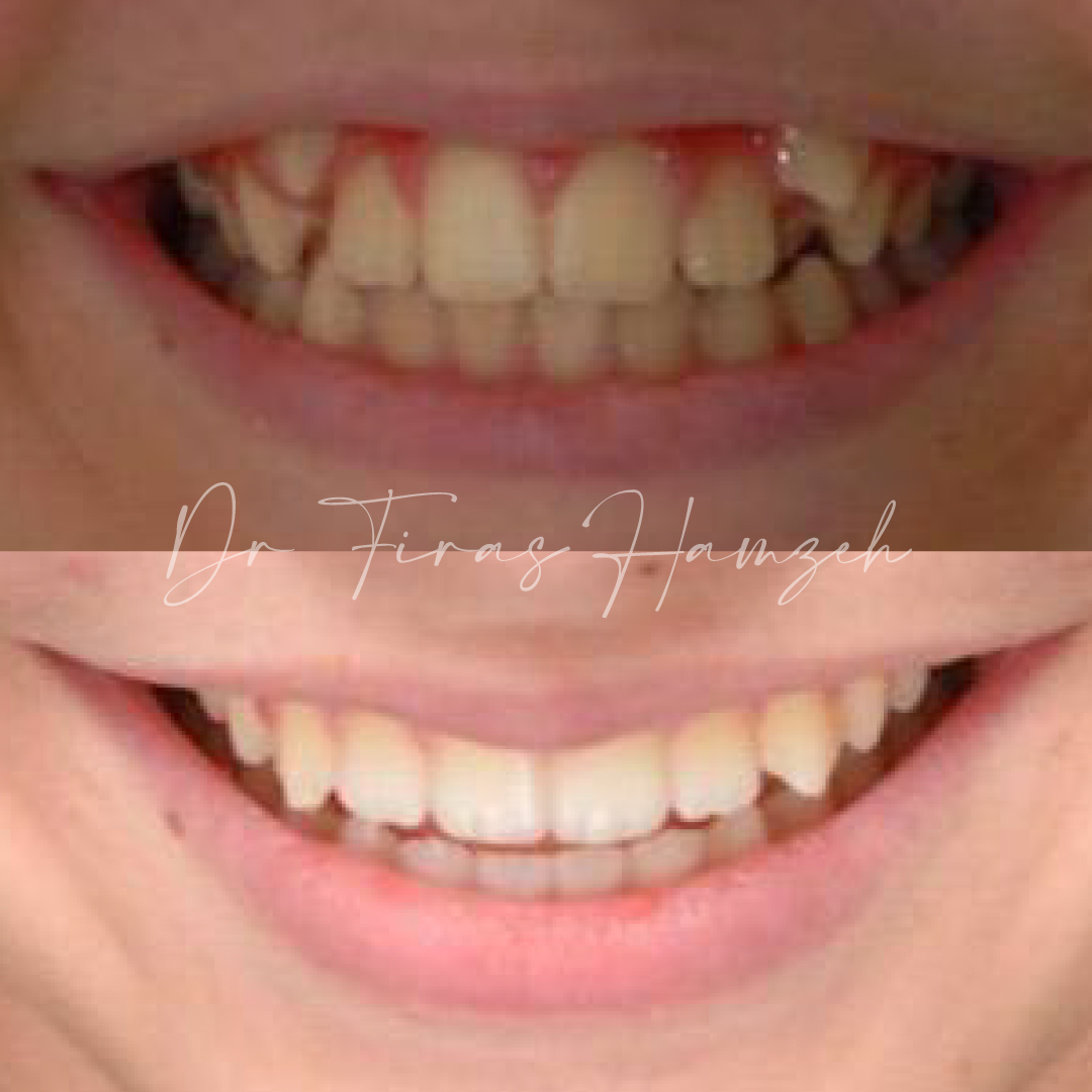 Spark Clear Aligners Treatment  in Dubai