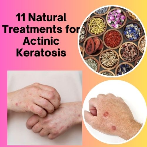 11 Natural Treatments for Actinic Keratosis - Herbal Care Products - Blog
