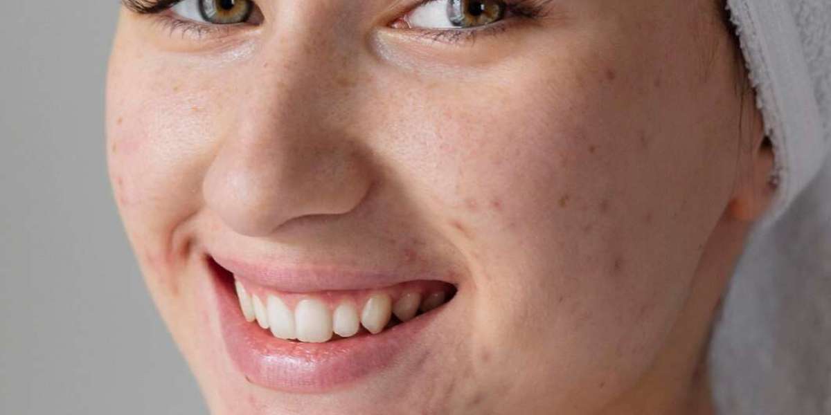 Clear Skin Confidence: Expert Acne Treatment in Beverly Hills