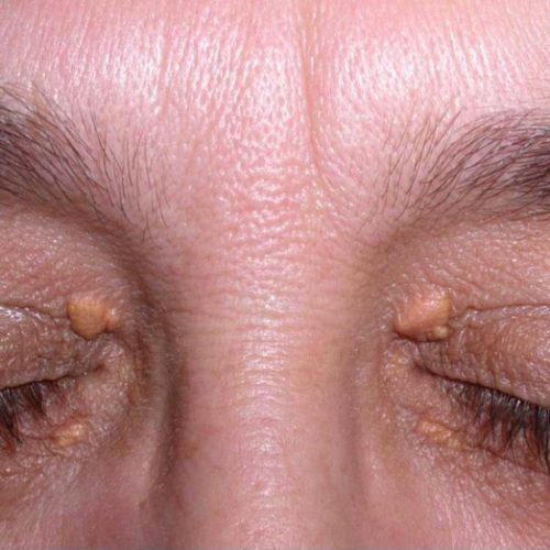 Best Xanthelasma Removal Treatment in Milton Keynes