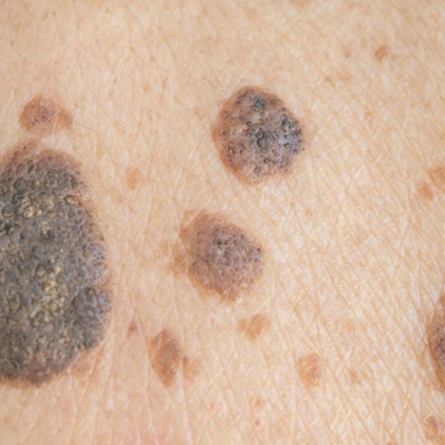 Professional Seborrheic Keratosis Removal in Milton Keynes