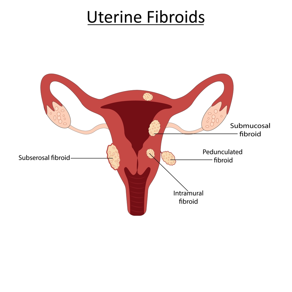Expert Uterine Fibroid Treatment in Columbus – 360 Vascular Institute