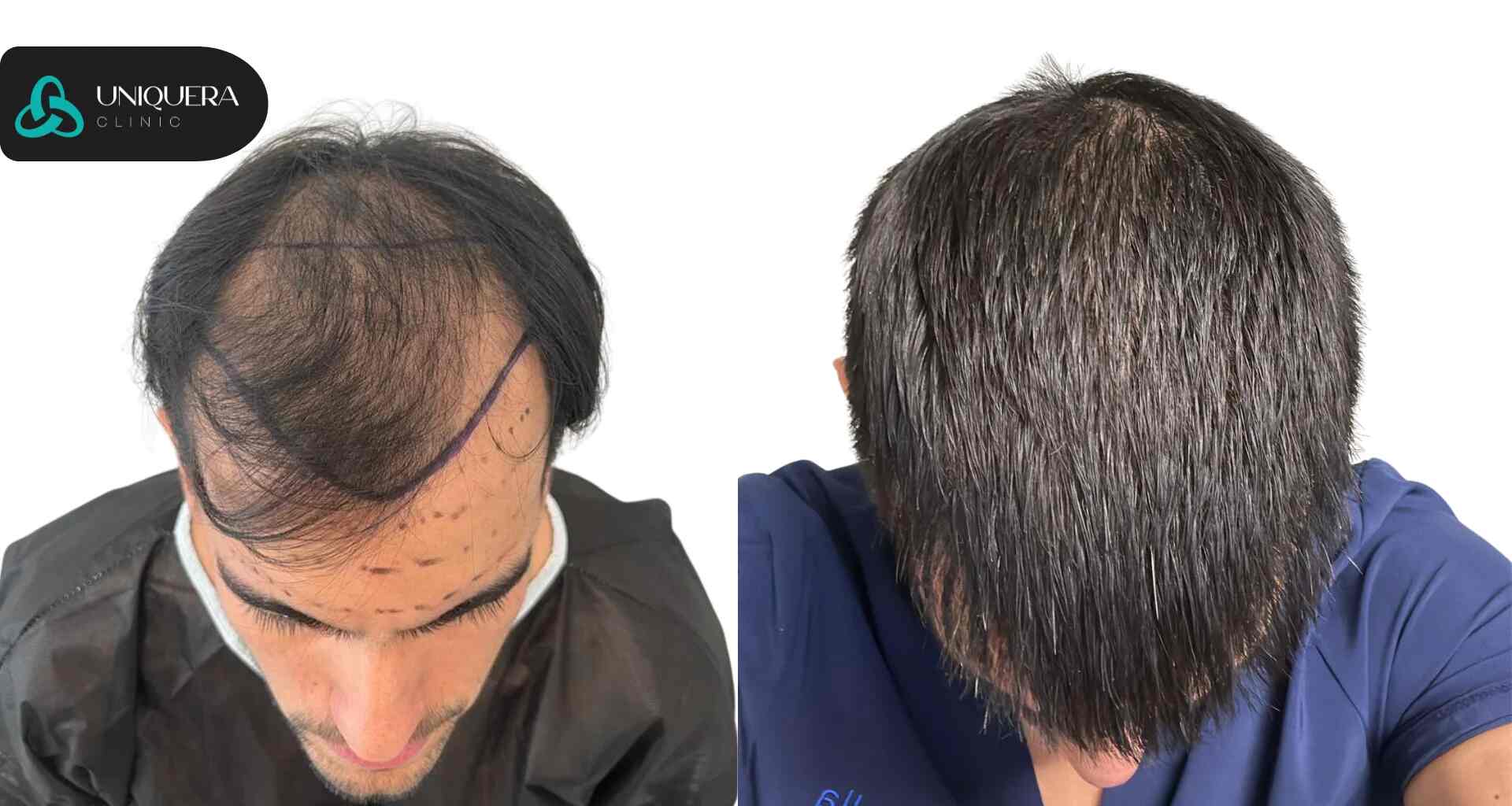 Hair Transplant Results: What to Expect After a Successful Surgery