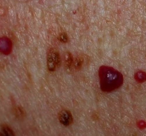 Effective Cherry Angioma Removal Treatment in Milton Keynes
