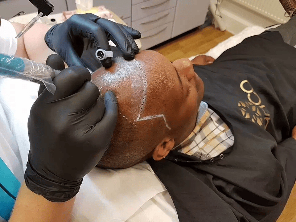 Advantages of SMP Hair Tattoo: Confidence, Style and Simplicity