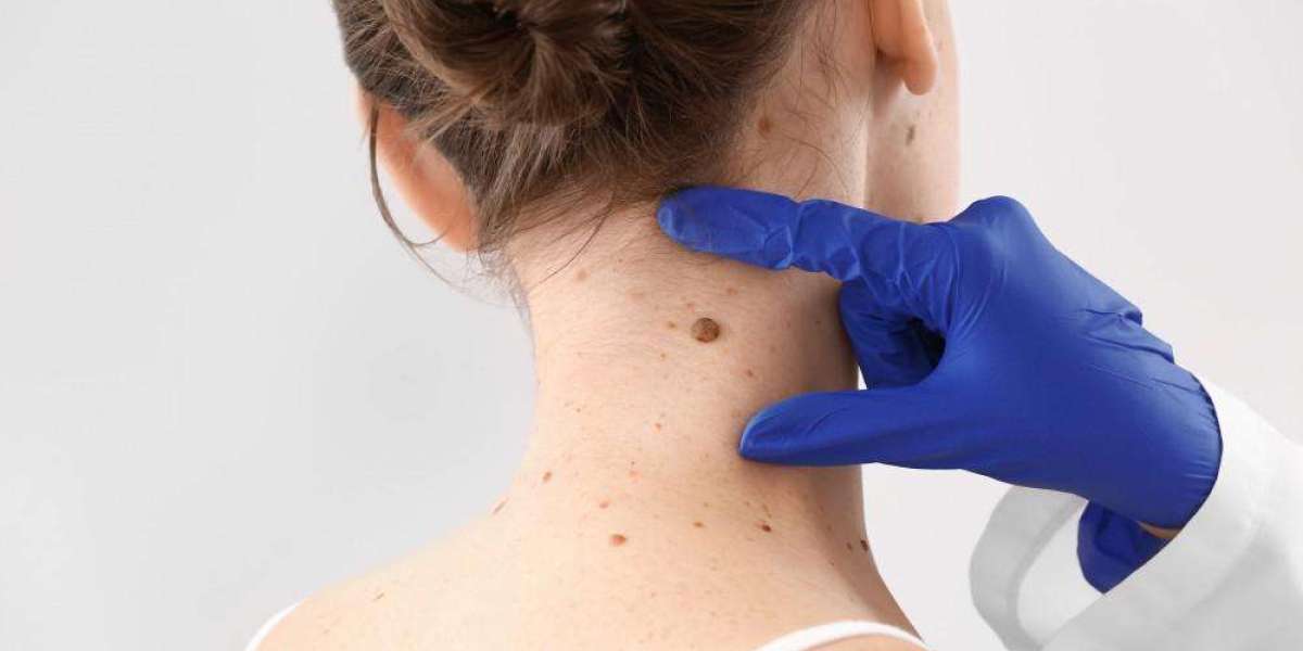 Skin Tag Removal Price | What You Need to Know Before Treatment