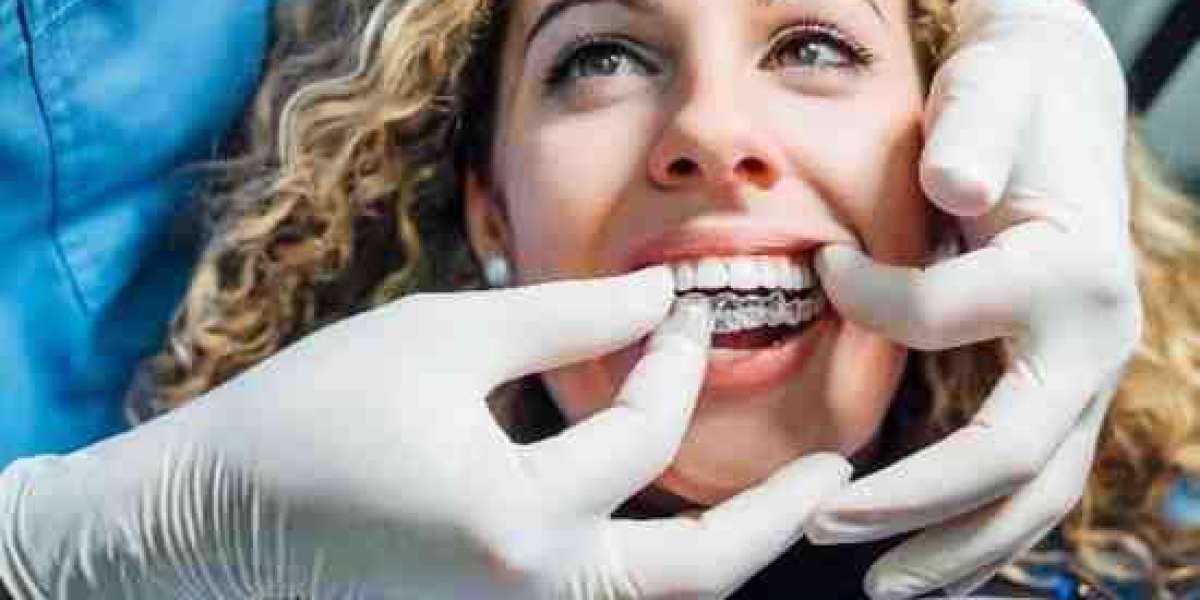 Can Invisalign Fix an Open Bite? Full Guide in Twickenham