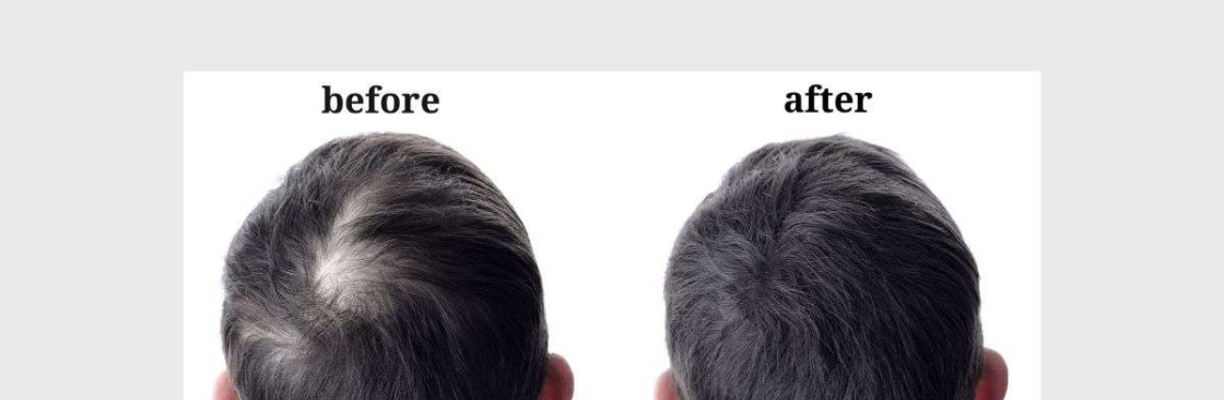 Srinagar Hair transplant Cover Image