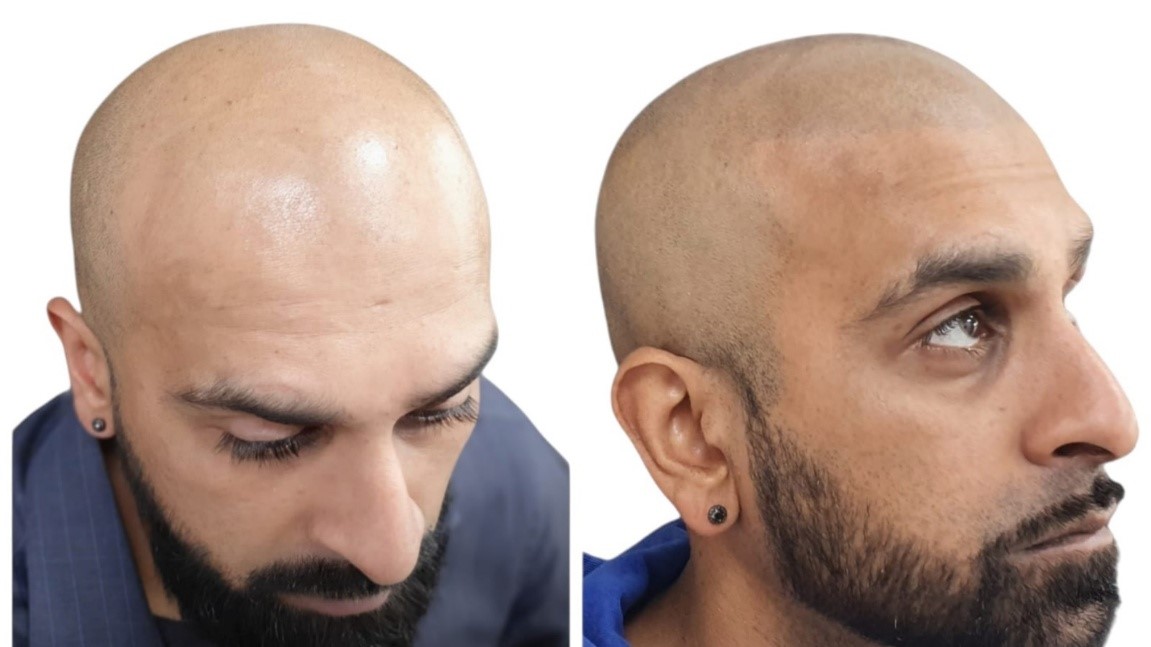 What is Scalp Micropigmentation: Meaning, Process & Benefits