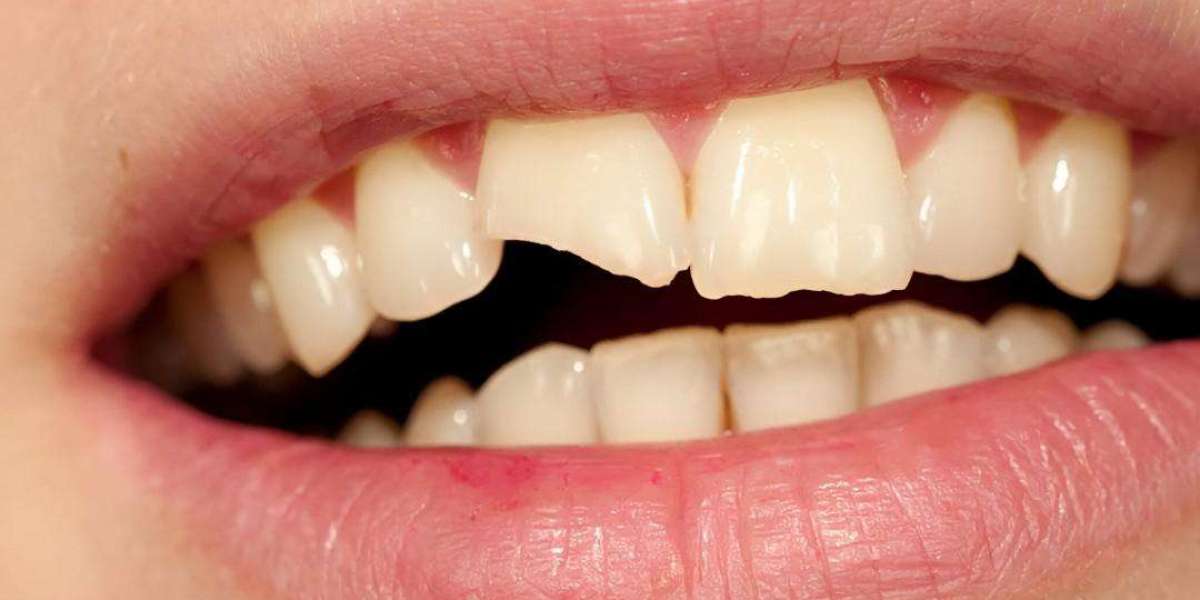Teeth Fracture Treatment in Islamabad | Smile Back Today