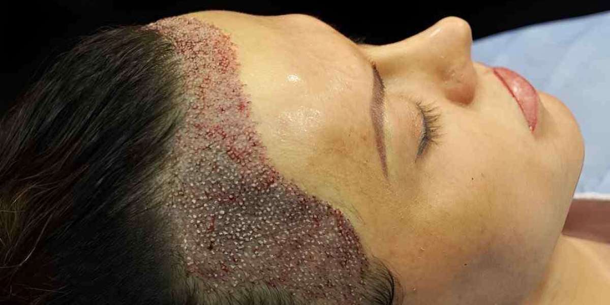 FUE Hair Transplant in Islamabad: Natural-Looking Hairline