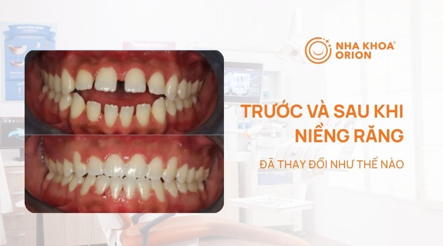 Hình ảnh thay đổi trước và sau khi niềng răng