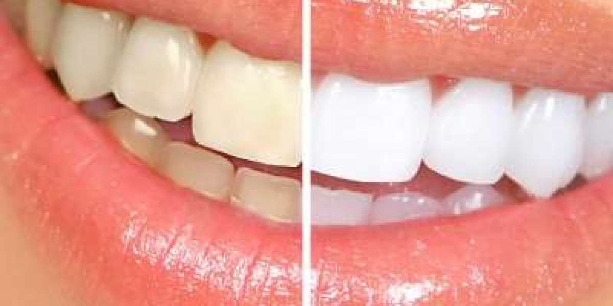 How Often Should You Get Teeth Whitening in Islamabad?
